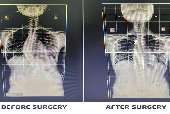 Caritas Hospital Comforted the Woman Who Came With Her Spinal Curvature