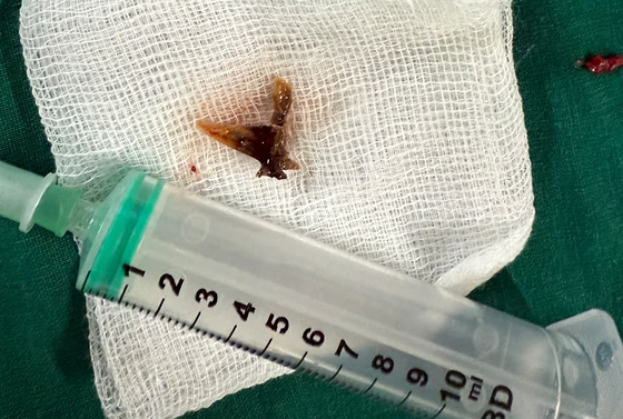 3-Year-Old Fish Bone Removed From Lung of Tanzanian National Without Surgery